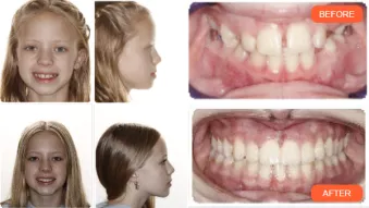 CASE STUDY: A Second Opinion and a Third Dimension Lead to Treatment Success . Before and after