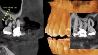 Clinical Case: Revealing Accurate Diagnoses with CBCT