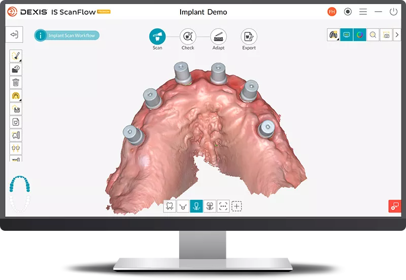DEXIS IS ScanFlow: Automatically acquire clean, accurate scanbodies