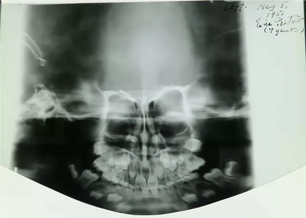 The world’s first panoramic X-ray of a patient’s skull