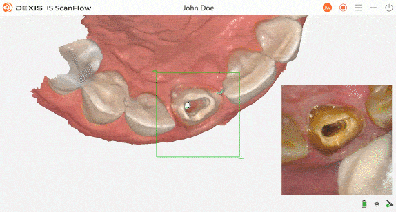 DEXIS Imprevo Sharp detail in tight spaces