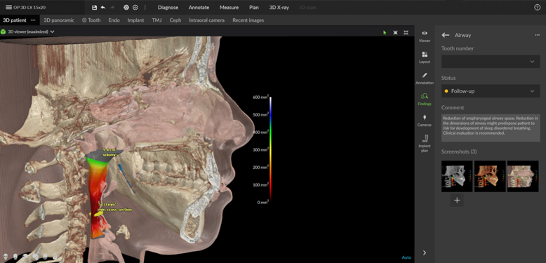 Airway