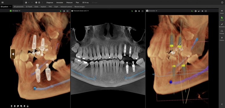 Implant