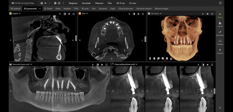 Implant Placement