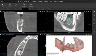 Abutment and implant planning