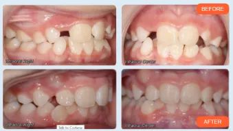 CASE STUDY by Dr Greenberg: Uncovering a Mesiodens with 3D Visualization