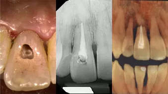 Case study by Dr Gaur: The diagnostic power of 3D imaging