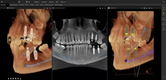 Implant
