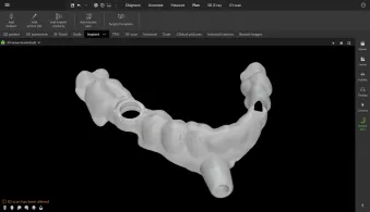 Printable surgical template