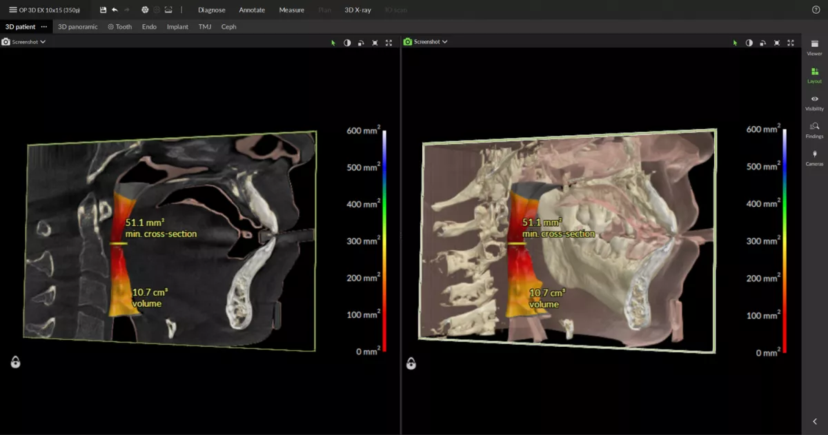 OP 3D EX - Airway analytsis