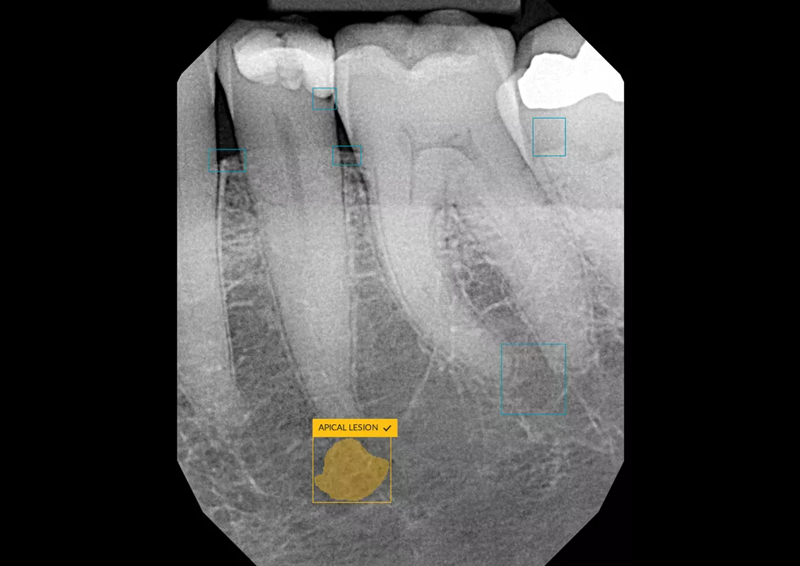 Apical lesion