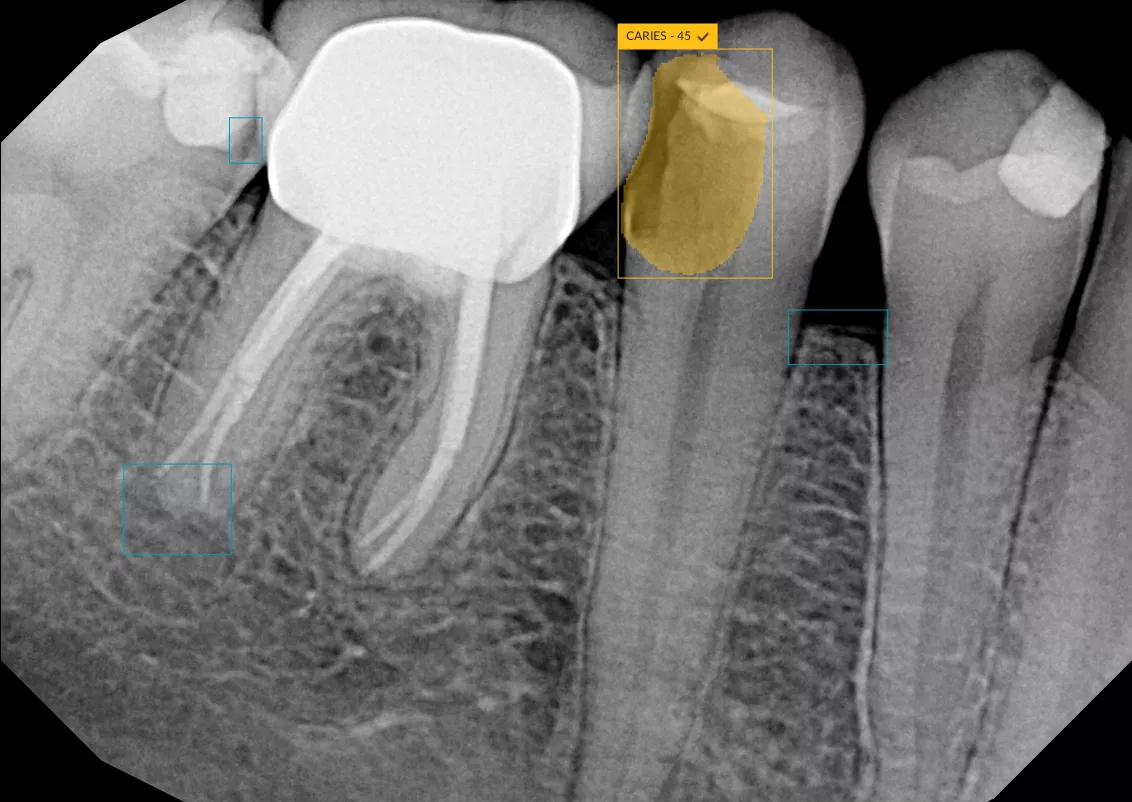 Caries