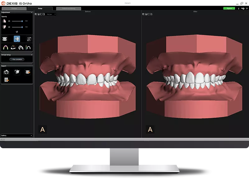DEXIS IS Ortho: setup dueal views before and after