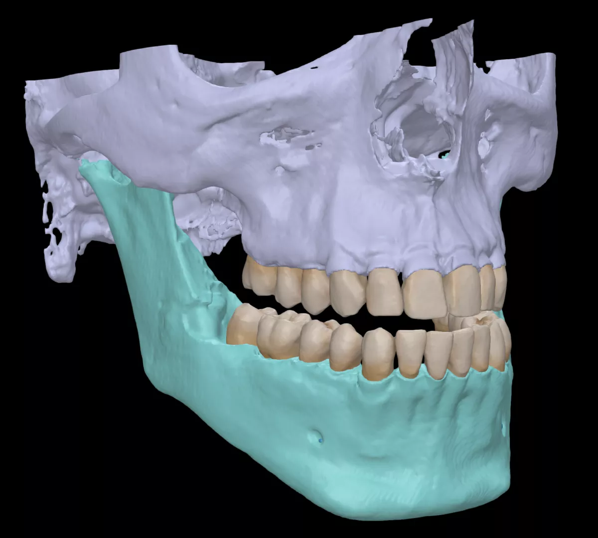 DTX Studio Clinic Segmentation of upper and lower teeth