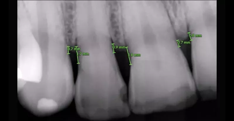 DTX Studio Clinic 2D Bone Height Measurement
