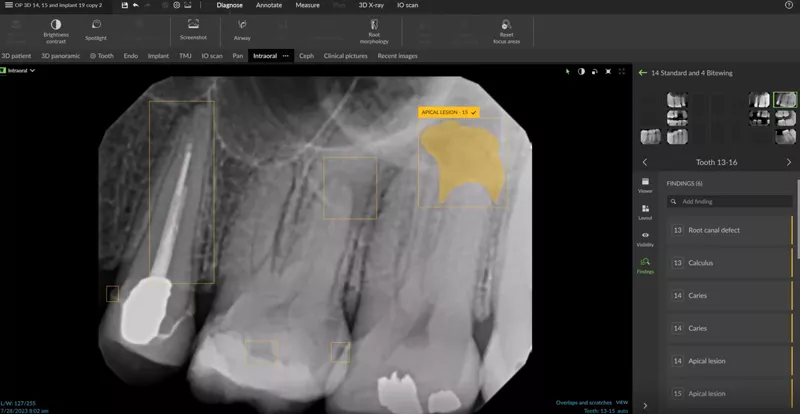 DTX Studio Clinic Identify and highlight common dental findings using AI