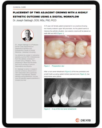 Clinica case by Dr Sabbagh: Placement of Two Adjacent Crowns with a Highly Esthetic Outcome Using a Digital Workflow