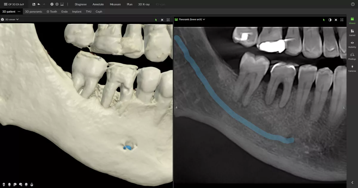 OP 3D EX - Gum disease