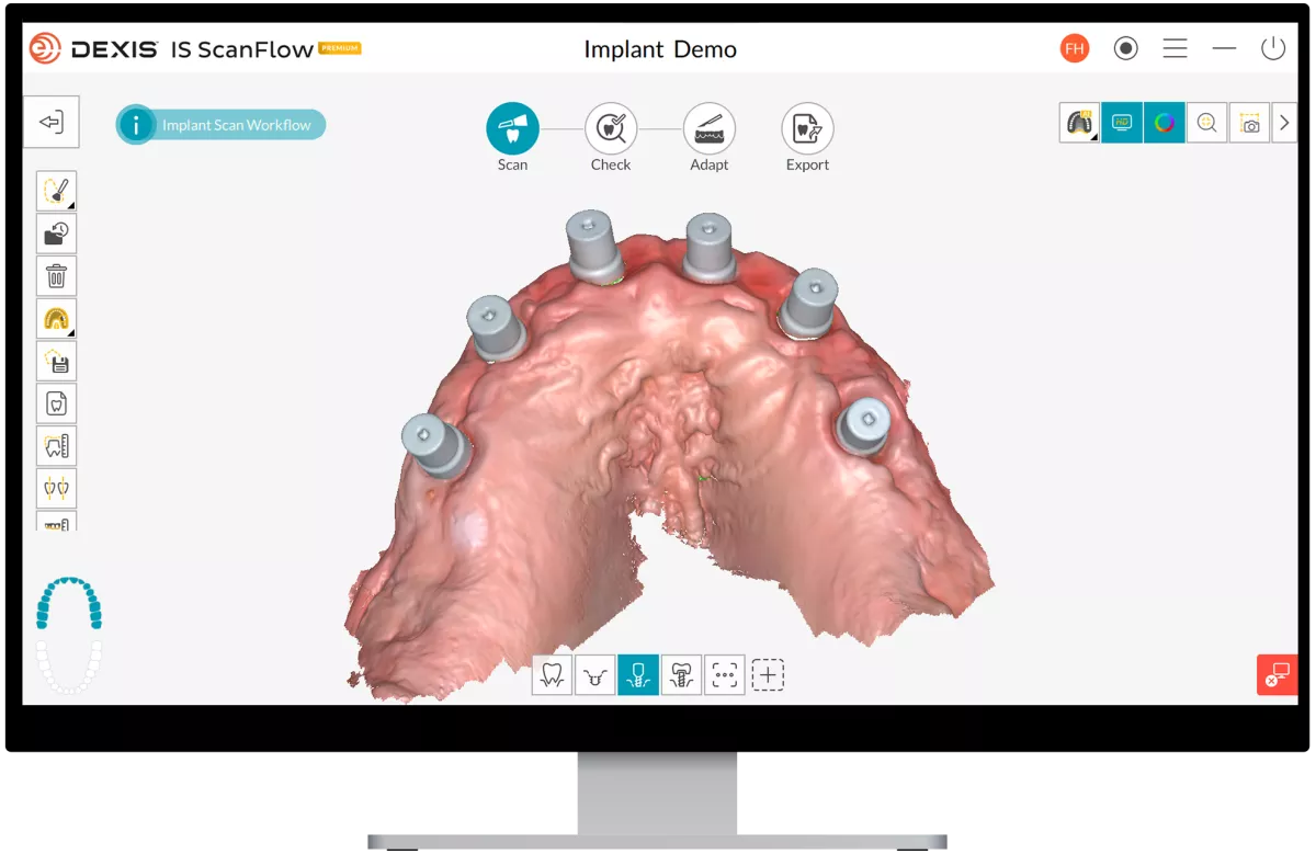 DEXIS IS ScanFlow 1.0.9.2: Scanbody