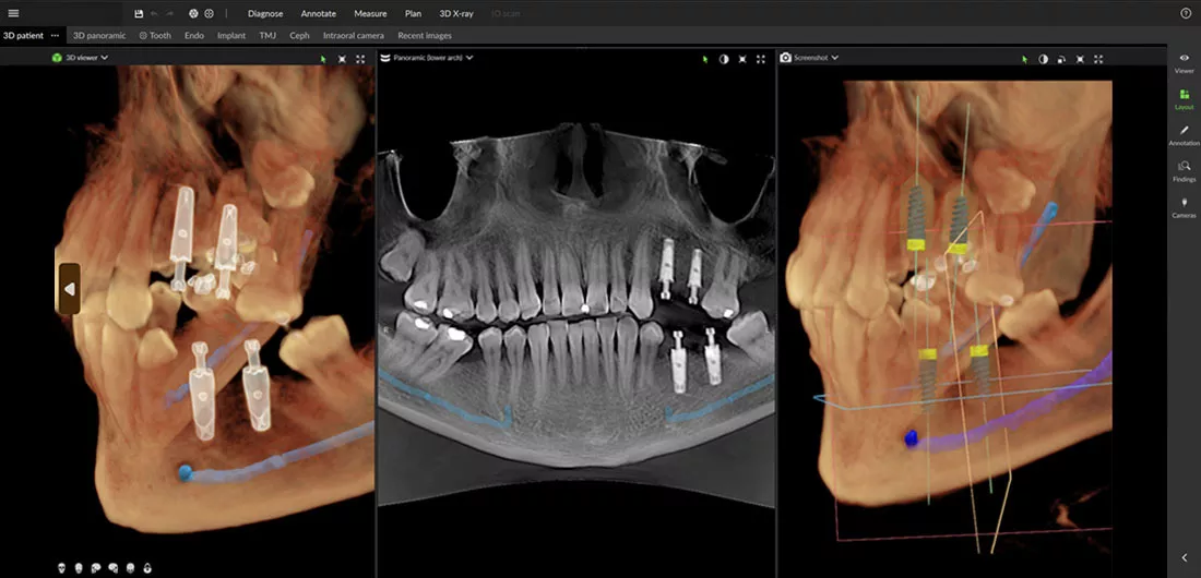 Implant