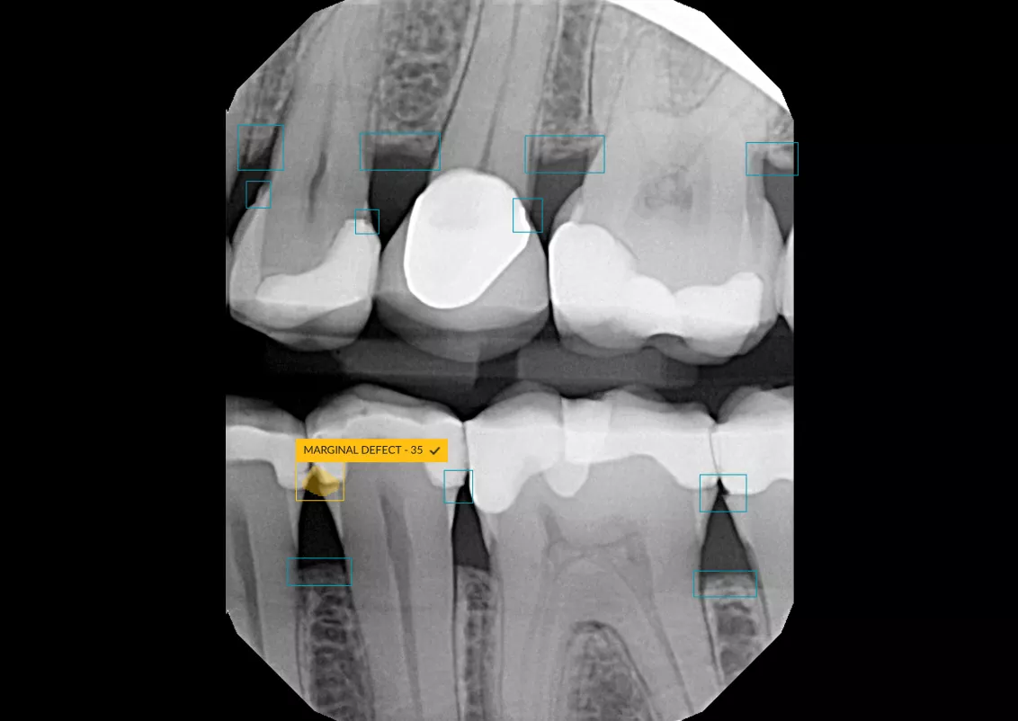 Marginal defect