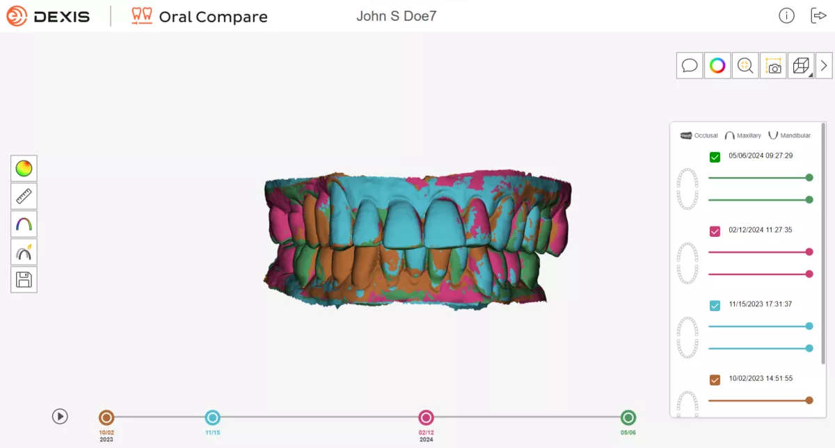 Oral Compare Superimposition