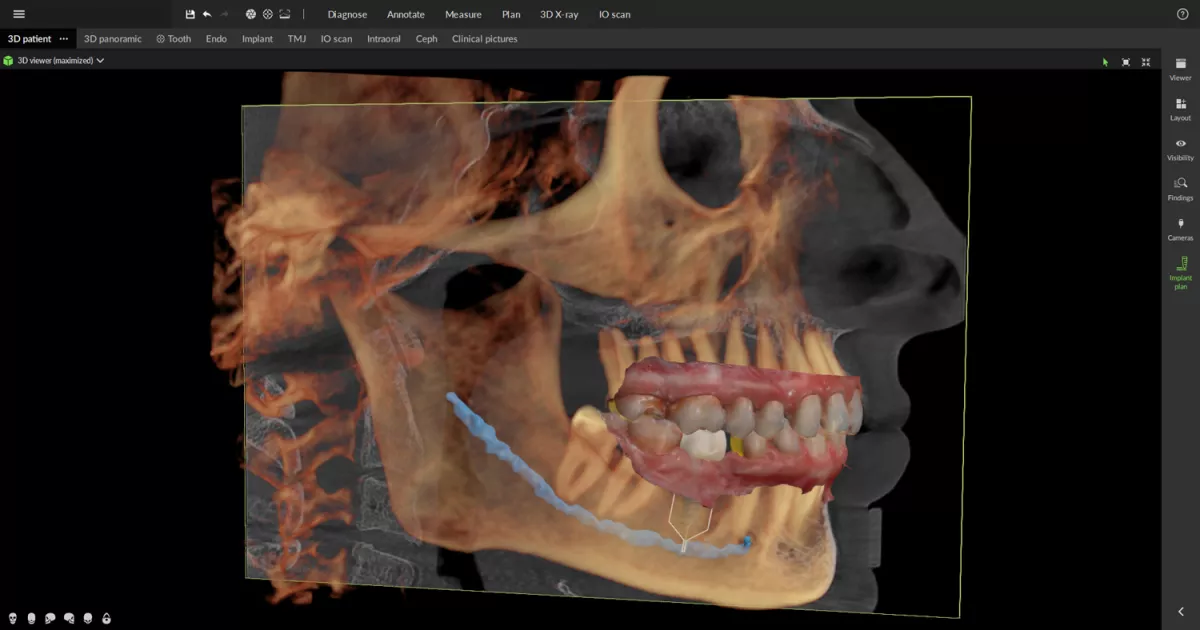 OP 3D EX - Restorative