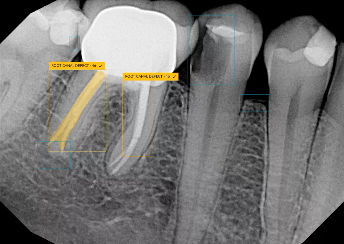 Root Canal