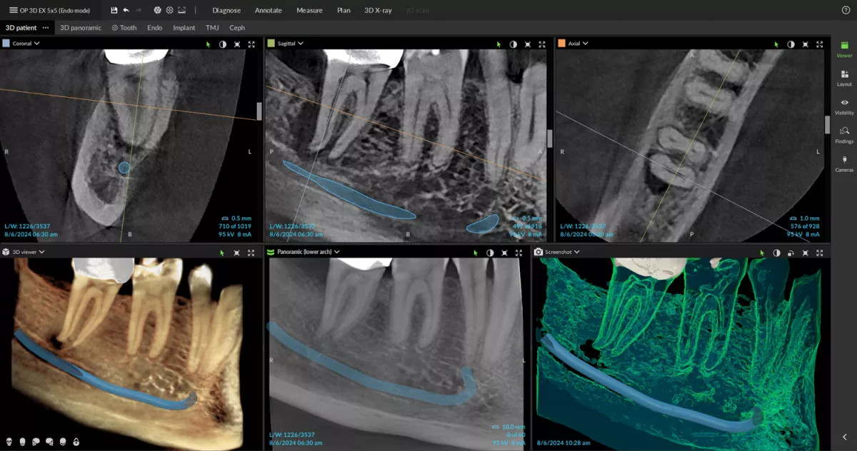 OP 3D EX - Root canals