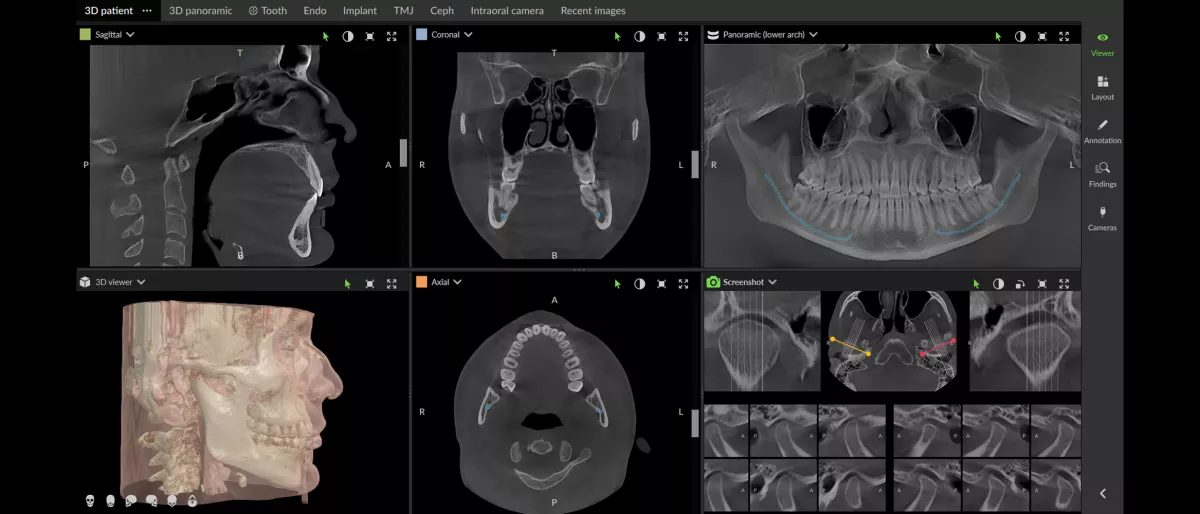 Stitch-free scan