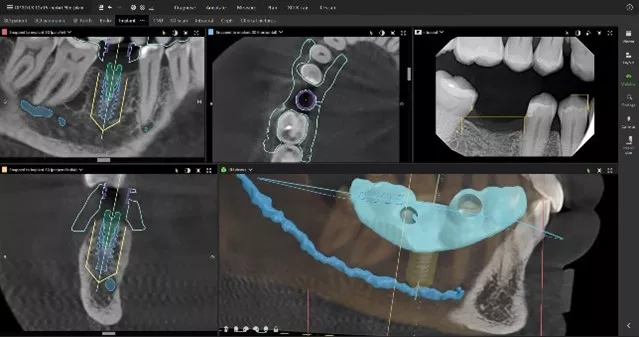 enables users to generate surgical guides DTX studio clinic