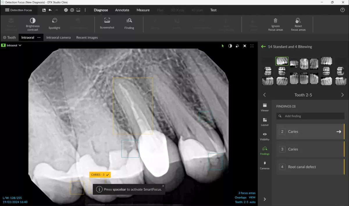 Identifies up to 6 common dental findings DTX